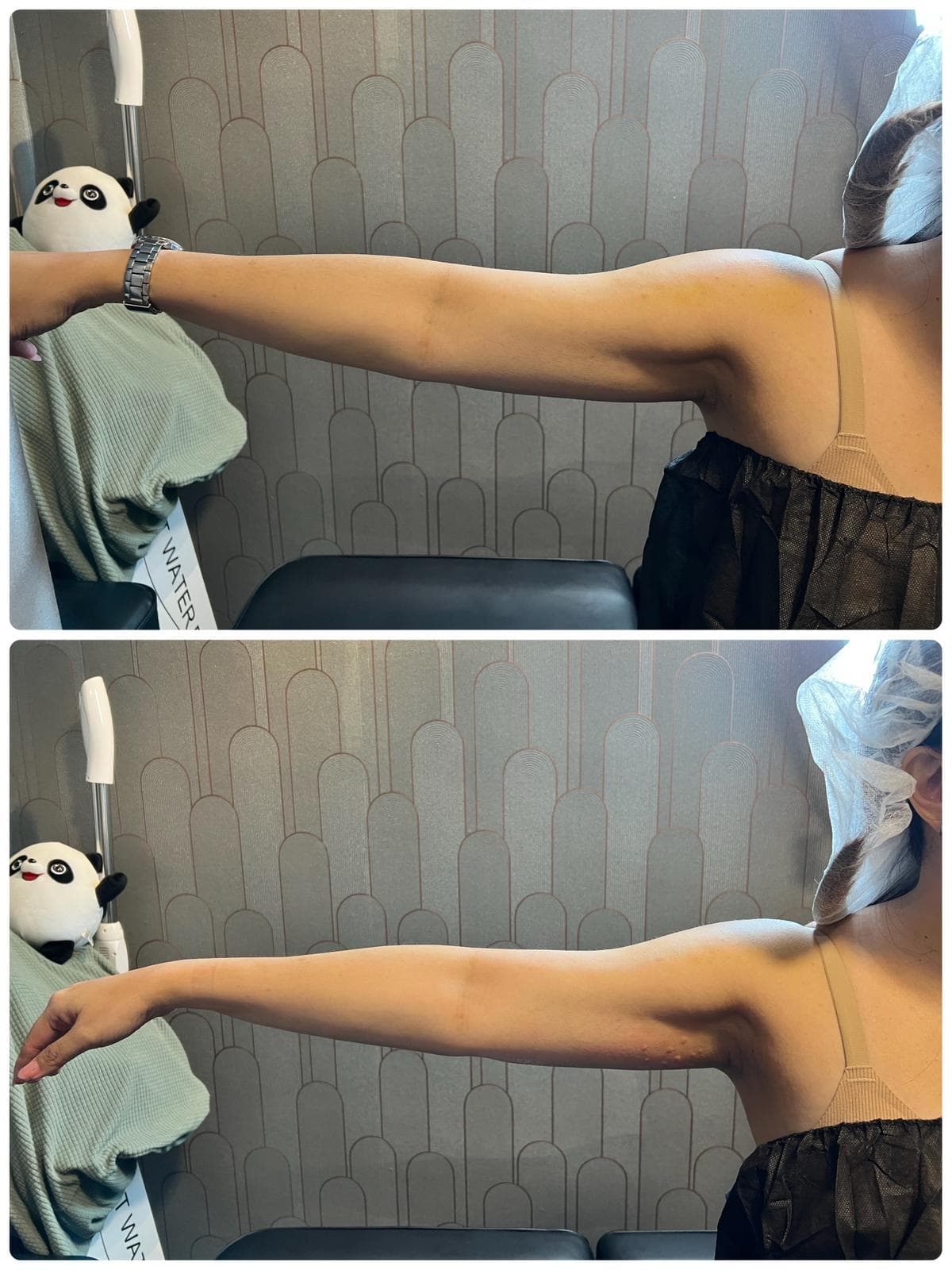 Arm fat reduction client result reference 3